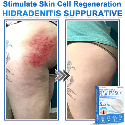📌 Awzlove® 2-in-1 Microneedle & Hydrocolloid Patch | Raised Moles,Acne,  Flat Warts & Skin Tags Remover | Improves Wrinkles, Scars & Blemishes | Invisible Star Pimple Patches for Face & Body | 🎁