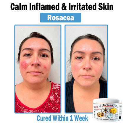 TODAHOF™ Bee Venom Multi-Symptom Skin Treatment Cream (👨‍⚕NPF RECOMMENDS) 💌