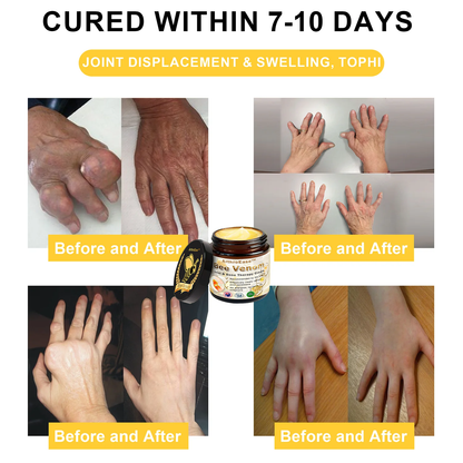 ArthroEase Bee Venom Arthritis Therapy Cream(Specially for older adults & AOA recommends)