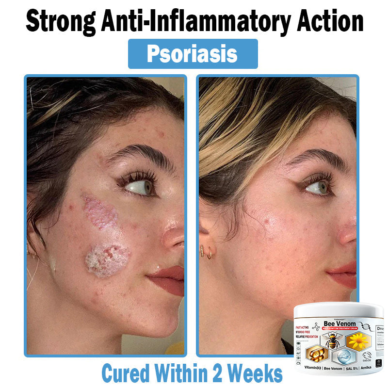 TODAHOF™ Bee Venom Multi-Symptom Skin Treatment Cream (👨‍⚕NPF RECOMMENDS) 💌