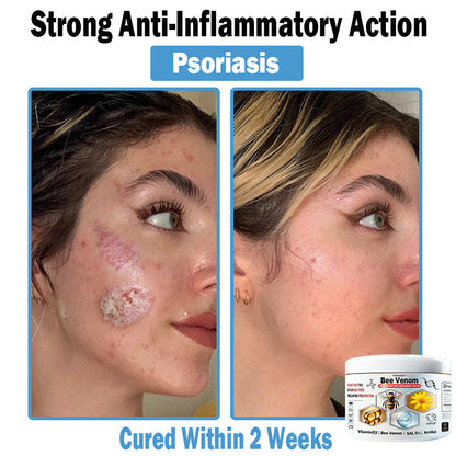 TODAHOF™ Bee Venom Multi-Symptom Skin Treatment Cream (👨‍⚕NPF RECOMMENDS) 💌