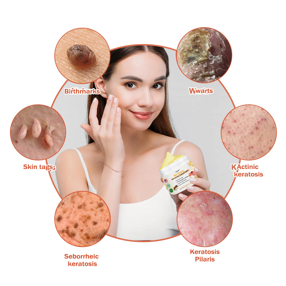 👩‍⚕️[🌟𝐎𝐟𝐟𝐢𝐜𝐢𝐚𝐥 𝐁𝐫𝐚𝐧𝐝 𝐒𝐭𝐨𝐫𝐞🌟] 𝐀𝐰𝐳𝐥𝐨𝐯𝐞™ 𝐁𝐞𝐞 𝐕𝐞𝐧𝐨𝐦 𝐌𝐨𝐥𝐞 𝐚𝐧𝐝 𝐖𝐚𝐫𝐭 𝐓𝐫𝐞𝐚𝐭𝐦𝐞𝐧𝐭 𝐂𝐫𝐞𝐚𝐦