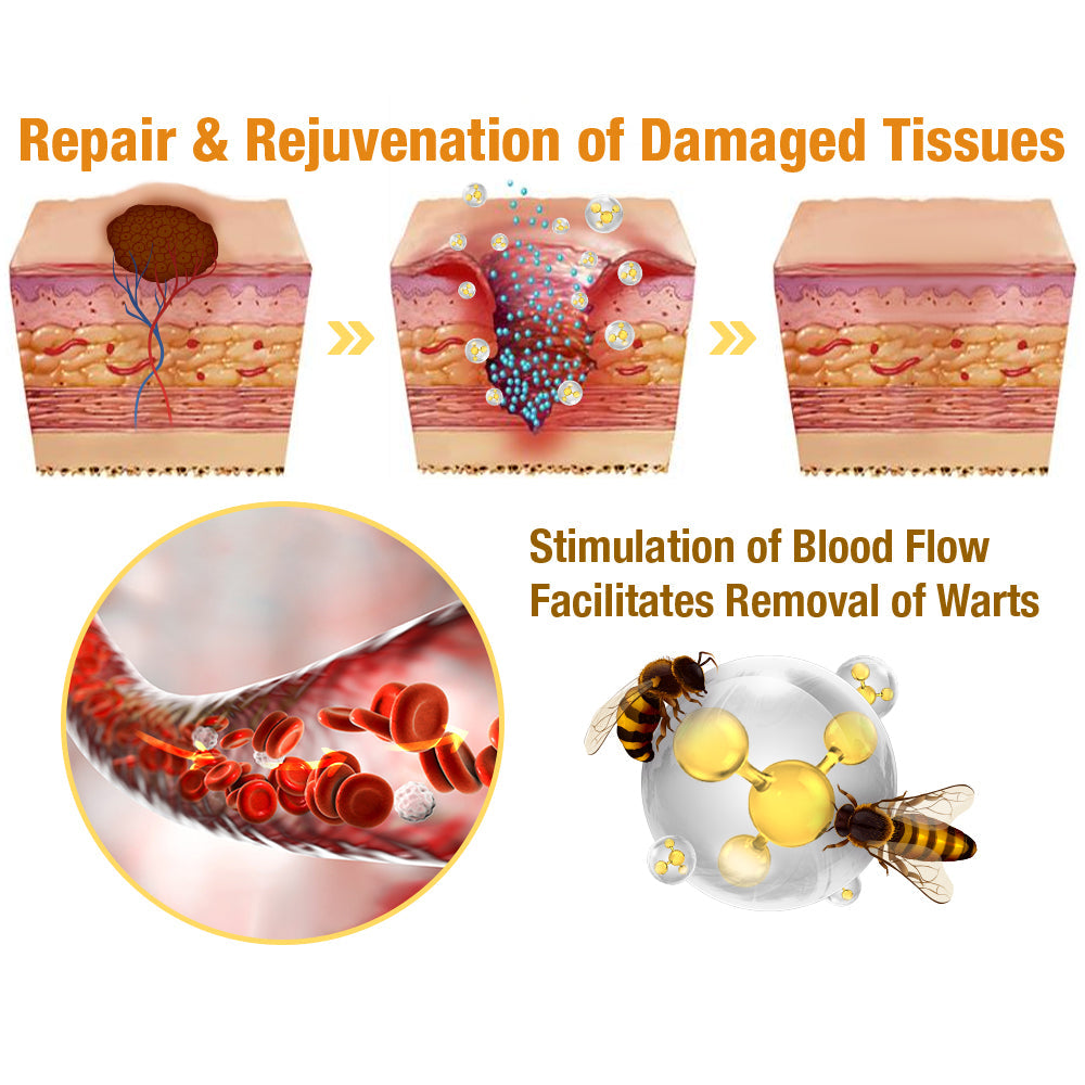 👩‍⚕️[🌟𝐎𝐟𝐟𝐢𝐜𝐢𝐚𝐥 𝐁𝐫𝐚𝐧𝐝 𝐒𝐭𝐨𝐫𝐞🌟] 𝐀𝐰𝐳𝐥𝐨𝐯𝐞™ 𝐁𝐞𝐞 𝐕𝐞𝐧𝐨𝐦 𝐌𝐨𝐥𝐞 𝐚𝐧𝐝 𝐖𝐚𝐫𝐭 𝐓𝐫𝐞𝐚𝐭𝐦𝐞𝐧𝐭 𝐂𝐫𝐞𝐚𝐦